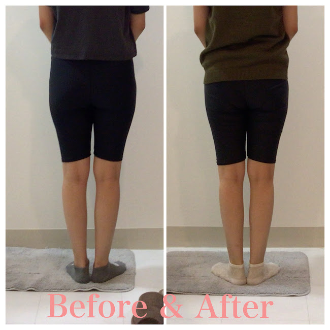 骨盤矯正、産後の骨盤矯正