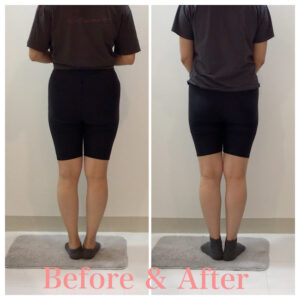 骨盤矯正、産後の骨盤矯正、小尻