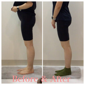 骨盤矯正、産後の骨盤矯正