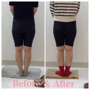 骨盤矯正、産後の骨盤矯正