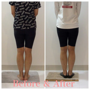 骨盤矯正、産後の骨盤矯正