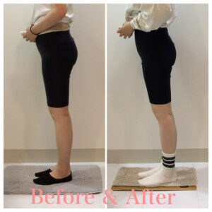 骨盤矯正、産後の骨盤矯正