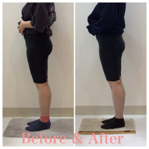 産後の骨盤矯正、骨盤矯正