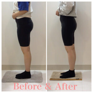 骨盤矯正、産後の骨盤矯正