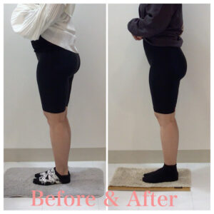 骨盤矯正、産後の骨盤矯正