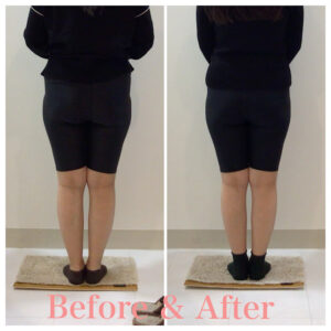 骨盤矯正、産後の骨盤矯正