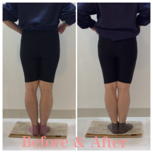 骨盤矯正、産後の骨盤矯正